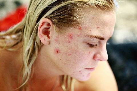 Pimples हटाने के उपाय व् नुस्खे 